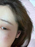 SWEETCHIC醫(yī)用輔助傷口快速愈合促進(jìn)長肉非藥修復(fù)擦傷燙傷褥瘡消殺炎菌噴霧 醫(yī)用創(chuàng)面敷料 30ml新老包裝交替發(fā)貨 曬單實(shí)拍圖