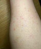 大腿毛囊炎藥膏腿上毛孔堵塞專用疏通干燥皮膚起痘痘瘙癢長膿包丘疹雞皮膚疙瘩毛囊角化專用去除大腿胳膊 單盒（體驗裝） 曬單實拍圖