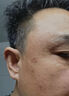 維A酸乳膏去疣體特新效期藥扁平疣專用藥去疣類藥膏去脖子小肉粒頸部瘊子去尤瘊小肉粒去疣膏瘊子肉刺肉粒 1盒裝【國藥準(zhǔn)字脫疣瘊】 瘊子去除國藥準(zhǔn)字藥膏  放心購買 安心售后 曬單實拍圖