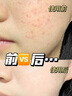 Masata新加坡進(jìn)口青少年洗面奶150ml*2 控油祛痘除螨去黑頭粉刺 曬單實拍圖