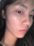 維特絲祛痘藥膏50g壬二酸水楊酸去痘痘和收毛孔閉口粉刺男女精華 曬單實(shí)拍圖