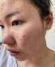 清熱解毒痤瘡i丸 消炎痤瘡專用藥口服臉上去痘痘的藥 粉刺閉口青春痘膿皰瘡皮膚用藥 清熱暗瘡?fù)?2暗瘡?fù)?1排毒養(yǎng)顏片【治反復(fù)長痤瘡 活血排毒】 曬單實拍圖