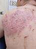 阿昔洛韋乳膏凝膠軟 帶狀皰疹后遺癥神經(jīng)痛用藥斷貨根 蛇盤(pán)瘡生殖器皰疹也可用抗病毒軟膏【視覺(jué)特效】 1盒【建議多盒使用】 曬單實(shí)拍圖