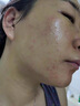 儒意（RUYI）水楊酸面膜20片祛痘淡痘印果酸控油清潔收縮毛孔女男士補(bǔ)水青少年 曬單實(shí)拍圖