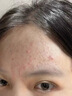 維特絲祛痘藥膏50g壬二酸水楊酸去痘痘和收毛孔閉口粉刺男女精華 曬單實拍圖