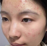 OHBT祛痘膏60g青春痘閉孔粉刺收縮毛孔專用學生男女凝膠男士化妝品 曬單實拍圖