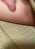股癬大腿內側真菌感染腹股溝股蘚大腿根瘙癢特專(zhuān)效藥體癬花斑癬銅錢(qián)癬潮濕男士私處發(fā)黑止癢皮膚用藥克霉唑乳 1盒克霉唑乳膏素+1盒鹽酸特比荼芬噴霧劑非處方藥 曬單實(shí)拍圖