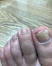 DR.JOINTNA制藥德國灰指甲專用指甲真菌感染脫甲壞甲發(fā)黃增厚特效進(jìn)口鳳仙花 曬單實拍圖
