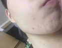 YZKMSKIN洗面奶控油祛痘除螨蟲去黑頭祛痘消炎痤瘡專用青少年成年清潔毛孔 控油祛痘洗面奶） 110ml 【單瓶裝 曬單實拍圖