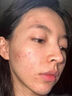 維特絲壬二酸祛痘藥膏去痘痘粉刺閉口收縮毛孔男女煙酰胺水楊酸 曬單實拍圖