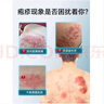 靈眷仙凡速平凝膠官方旗艦店醫(yī)用退熱止癢細(xì)菌凝膠溫和天官方正品旗艦店 1盒(跪在運(yùn)費(fèi)) 曬單實(shí)拍圖