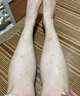 葵花蚊蟲叮咬疤痕修復兒童去黑印淡化黑色素蚊子蟲咬祛疤印專用凝膠膏 去疤痕修復去除黑印蚊子咬的疤 曬單實拍圖