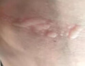 復方醋酸地塞米松乳膏皮膚瘙癢止癢抑菌皮膚瘙癢身體癢止癢皮炎濕疹真菌感染止癢膏100%特專(zhuān)效藥皮膚用藥 1盒裝【皮炎濕疹 皮膚瘙癢】下單送50支棉簽 曬單實(shí)拍圖