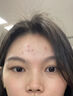維特絲壬二酸祛痘藥膏去痘痘粉刺閉口收縮毛孔男女煙酰胺水楊酸 曬單實拍圖
