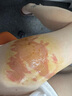 北宮潤玉燒燙傷膏燒燙傷皮膚隔離保護(hù)創(chuàng)面修復(fù)淡化外用軟膏 1盒輕度裝 15g 1盒 曬單實(shí)拍圖