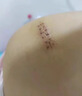 FALRUIER醫用祛疤膏硅酮疤痕凝膠去疤痕藥膏專(zhuān)用修復疤痕增生凸起去除疙瘩 五盒裝【增生凸起疙瘩疤痕】 曬單實(shí)拍圖