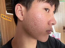 同仁堂祛痘印痘坑修復淡化痘坑修復凹洞黑色素沉淀淡化去痘痘和痘印粉刺 一盒裝【祛痘淡印】 曬單實(shí)拍圖