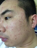 DRVIALY扁平疣專用尖銳濕疣去疣體瘊子特藥膏絲狀疣型瘊靈去除脖子小肉粒 3盒裝【頑固疣體-100%特效果】 曬單實(shí)拍圖