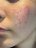 維特絲祛痘藥膏50g壬二酸水楊酸去痘痘和收毛孔閉口粉刺男女精華 曬單實(shí)拍圖