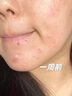 透真控油祛痘水乳套裝茶樹油修復(fù)痘印收縮毛孔補(bǔ)水爽膚水青少年護(hù)膚品 曬單實(shí)拍圖
