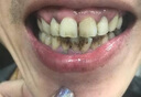 HIEUAILR胖東來牙垢牙結石專用去黃去牙漬去煙漬牙齒清潔器去除器搭牙膏 曬單實拍圖
