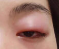 杰沐康麥粒腫眼貼霰粒腫臉板腺堵塞紅腫熱痛異物感眼睛腫去浮腫疏通消腫 一盒裝 曬單實(shí)拍圖