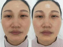三代眼部大師臉部抗衰儀器美容院優(yōu)仙提拉緊致消除去皺淡化黑眼圈 三代眼部大師(無(wú)需刷卡)送凝膠 曬單實(shí)拍圖