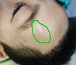 Hirudoid泰國喜遼妥疤痕膏 燙傷痘印凹疤增生修復(fù) 刀疤雙眼皮妊娠紋剖腹產(chǎn) 泰國原裝 40g 1盒 曬單實(shí)拍圖