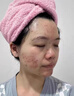 維特絲壬二酸祛痘藥膏去痘痘粉刺閉口收縮毛孔男女煙酰胺水楊酸 曬單實拍圖