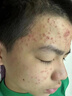 南京同仁堂膠態(tài)硫祛痘藥膏去痘痘和痘印消除痘坑修復去粉刺閉口精華 曬單實拍圖