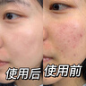 泊紫汀蘭祛痘膏祛痘淡化痘印消閉口修護(hù)痘痕痘坑去粉刺控油青春痘男女學(xué)生 曬單實(shí)拍圖
