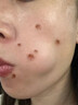 dyey點痣膏無痕去痣黑痣瘊子點痣液扁平尤絲狀尤尖尤肉刺肉兒童可用 曬單實拍圖