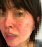 卡倫亞女痘痘修復(fù)面膜人源化膠原蛋白貼修護痘印5片敏感肌美容激光修復(fù) 10盒 曬單實拍圖