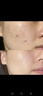 維特絲祛痘藥膏50g壬二酸水楊酸去痘痘和收毛孔閉口粉刺男女精華 曬單實(shí)拍圖