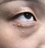 脂肪粒去除藥膏眼部專用神器去眼周小顆粒油脂粒眼霜消汗管瘤克星 一盒裝：專用精華素 曬單實拍圖