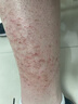 云南本草魚鱗皮膚專用的藥魚鱗皮膚霜魚鱗病腿紋路毛囊周角化脫皮起皮潤膚 魚鱗皮膚霜 曬單實拍圖