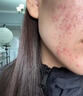 丹參酮膠囊祛痘消炎痤瘡專用治療痤瘡青少年臉上長痘痘吃什么藥口服內調抗菌消炎去火癤子青春痘硬疙瘩去痘痘 1盒裝【口服內服治痤瘡的中成藥】 曬單實拍圖