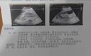 腎囊腫中藥貼腹部疼痛調(diào)理腰部腫塊腰疼血尿蛋白尿腎臟虛弱多囊腎積水腎虛虧益腎貼消除囊腫腎炎非藥中草貼Y 五盒裝 曬單實(shí)拍圖