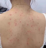 克林霉素甲硝唑搽劑 手臂毛囊炎專用特癢效藥 手臂毛囊炎長(zhǎng)痘痘胳膊上的小疙瘩有黑點(diǎn)堵塞藥皮膚用藥 1盒裝【標(biāo)準(zhǔn)裝】主治毛囊炎 曬單實(shí)拍圖