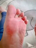 達克寧腳氣藥止癢脫皮爛腳丫真菌感染治腳氣達克寧硝酸咪康唑乳膏腳臭腳氣藥止癢真菌感染皮膚用藥 非處方藥 【治頑固腳氣】藥師推薦 達克寧腳氣藥止癢脫皮爛腳丫真菌感染治腳氣 曬單實拍圖