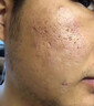 內(nèi)廷上用痘印痘坑修復(fù)凹洞去痘坑填充再生修復(fù)痘疤男凹坑淡化消除黑色素 痘印痘坑修復(fù)凹洞填充再生 一盒裝 曬單實拍圖