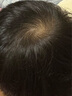 蔓迪 米諾地爾酊 5%濃度生發(fā)噴霧增發(fā)育發(fā)液男女防脫發(fā)嚴重脫發(fā)禿發(fā)米諾地爾治療脫發(fā)斑禿曼迪 2瓶90ml【贈三重好禮 生發(fā)療程推薦】 曬單實拍圖