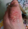 達(dá)克寧腳氣藥止癢脫皮爛腳丫真菌感染治腳氣達(dá)克寧硝酸咪康唑乳膏腳臭腳氣藥止癢真菌感染皮膚用藥 非處方藥 2盒【硝酸咪康唑乳膏】癢的受不了 老是摳腳 達(dá)克寧腳氣藥止癢脫皮爛腳丫真菌感染治腳氣 曬單實(shí)拍圖