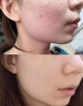 碧素堂（BISUTANG）硫磺洗面奶控油祛痘除螨去黑頭深層清潔面乳皂收縮毛孔男女士國貨 2支 【輕度痘痘肌推薦】 曬單實(shí)拍圖