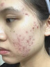 OHBT祛痘膏60g青春痘閉孔粉刺收縮毛孔專用學(xué)生男女凝膠男士化妝品 曬單實(shí)拍圖