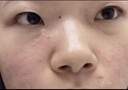 XIBELAON德國醫(yī)用疤痕貼增生凸起去除疙瘩燒燙傷剖腹產(chǎn)手術(shù)兒童減張祛疤膏 3盒18貼【新舊祛疤痕貼】 曬單實拍圖