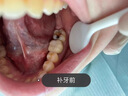 牙齒修復(fù)凝膠補(bǔ)牙洞神器材料永久自己在家樹脂醫(yī)用填充劑日本進(jìn)口 買3送2【蛀牙黑洞 齲齒】包治好 曬單實(shí)拍圖