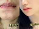 儒意（RUYI）水楊酸面膜20片祛痘淡痘印果酸控油清潔收縮毛孔女男士補(bǔ)水青少年 曬單實拍圖