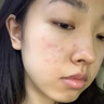 透真水楊酸祛痘面膜曬后修復積雪草毛孔收縮補水清潔控油祛痘男女士 曬單實拍圖