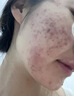 醫(yī)用痤瘡中藥去青春痘粉刺紅腫硬疙瘩痘印祛痘痘消炎痤瘡膿皰瘡去痘印青少年專用清熱暗瘡?fù)琛疽曈X特效】 3盒【療程裝】 曬單實(shí)拍圖
